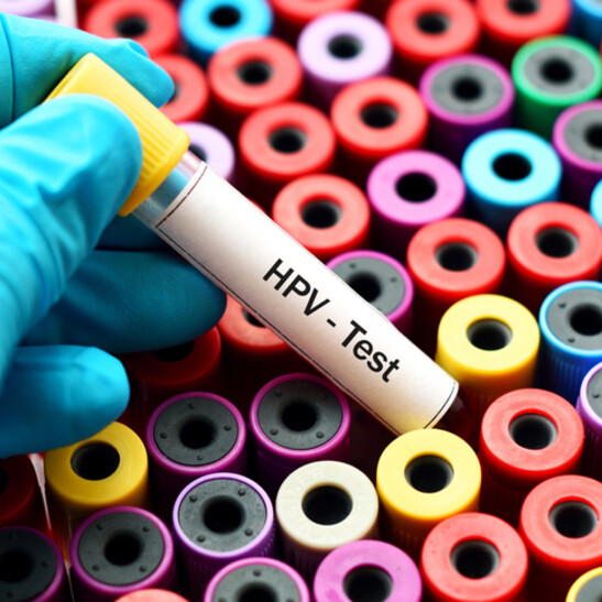 Test dell'Hpv. Attestazione: jarun011 - iStock