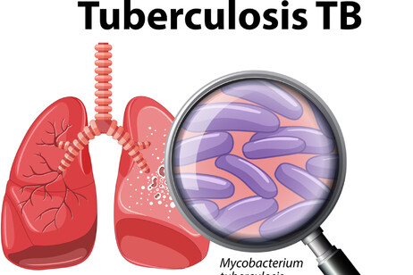 Tbc 'principale minaccia infettiva',8,2 milioni di casi nel 2023