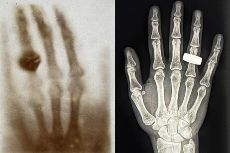 A sinistra  la prima radiografia medica realizzata 130 anni fa, accanto alla prima radiografia scattata nello spazio (a destra). Crediti: Foto: equipaggio Fram2 e chirurgo di volo Kaleigh Stabenau
