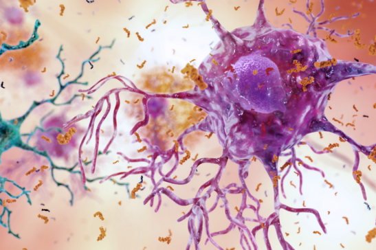 Le cellule nervose colpite dall'infiammazione nella malattia di Alzheimer (fonte: National Institute on Aging, NIH CC BY-NC 2.0)