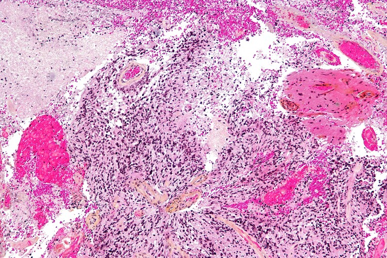 Cellule di glioblastoma (fonte: Nephron da Wikimedia CC BY-SA 3.0) - RIPRODUZIONE RISERVATA